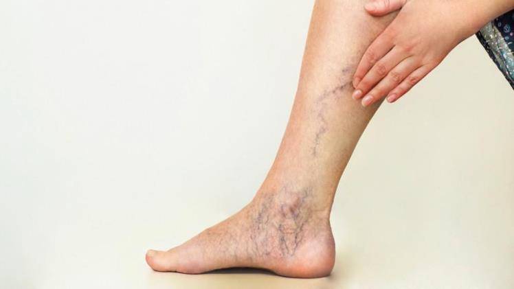 Dispelling Common Myths Concerning Spider Veins